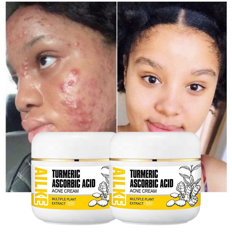 Ailke Turmeric Creams Best Anti Aging Pimple Beauty Products Skin Care Acne Face Cream For Women