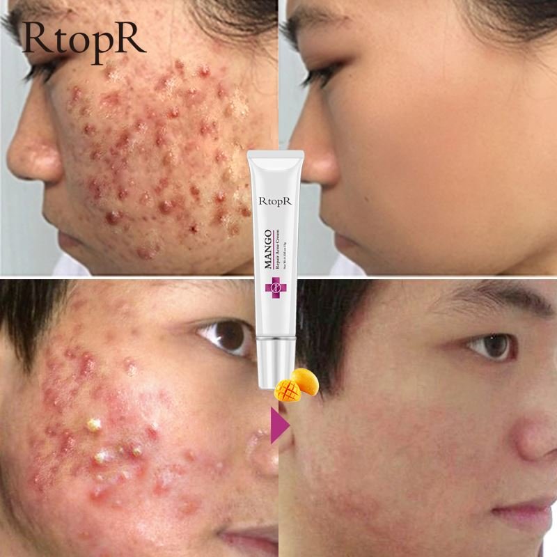 RtopR Acne Scar Stretch Marks Remover Cream Skin Repair Face Cream Acne Spots Acne Treatment Blackhead Whitening Cream Skin Care