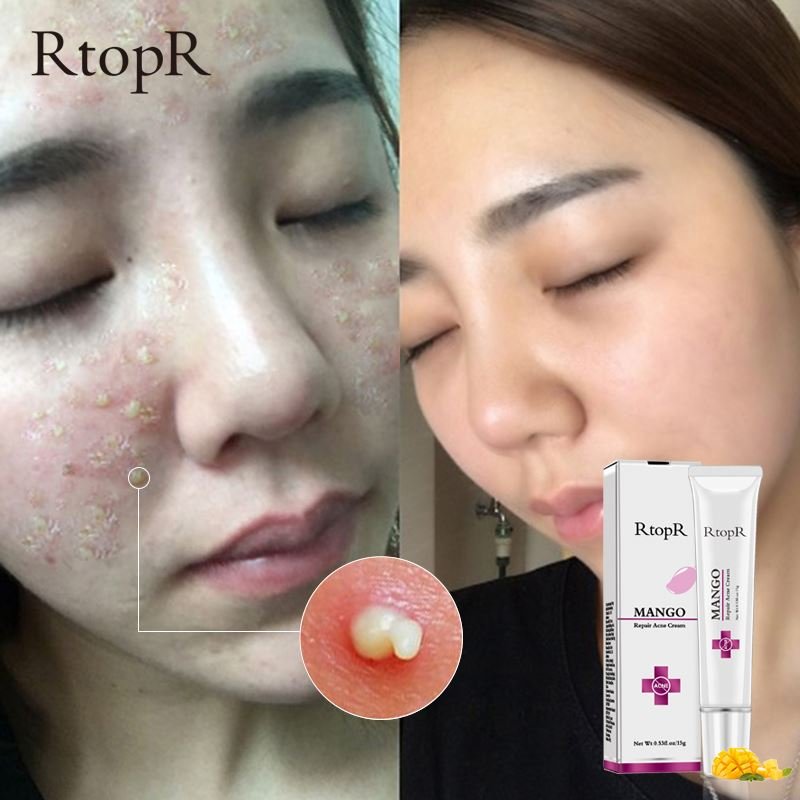 RtopR Acne Scar Stretch Marks Remover Cream Skin Repair Face Cream Acne Spots Acne Treatment Blackhead Whitening Cream Skin Care