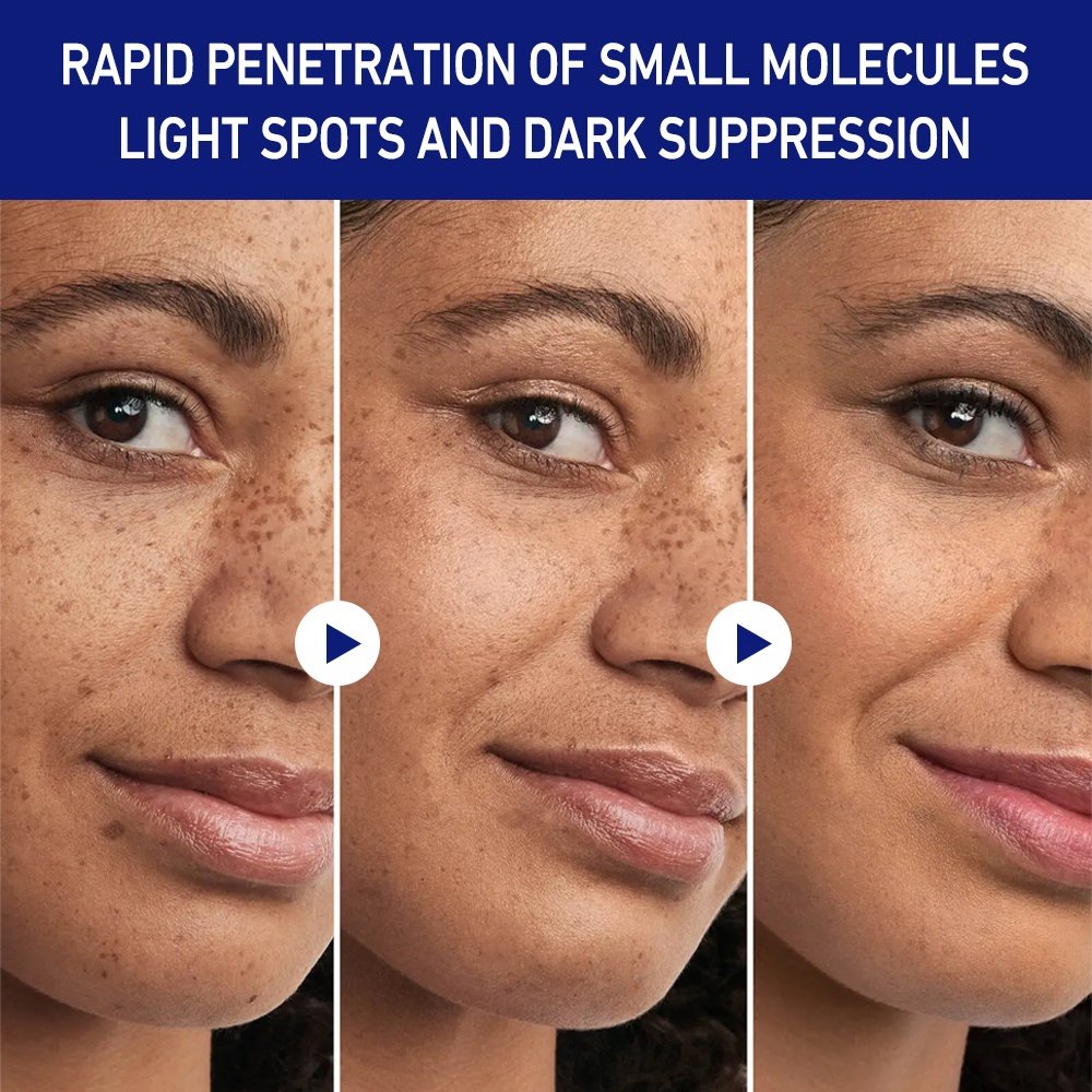 Removal Dark Spot Freckle Melasma,Strong Whitening Face Cream,Niacinamide Serum