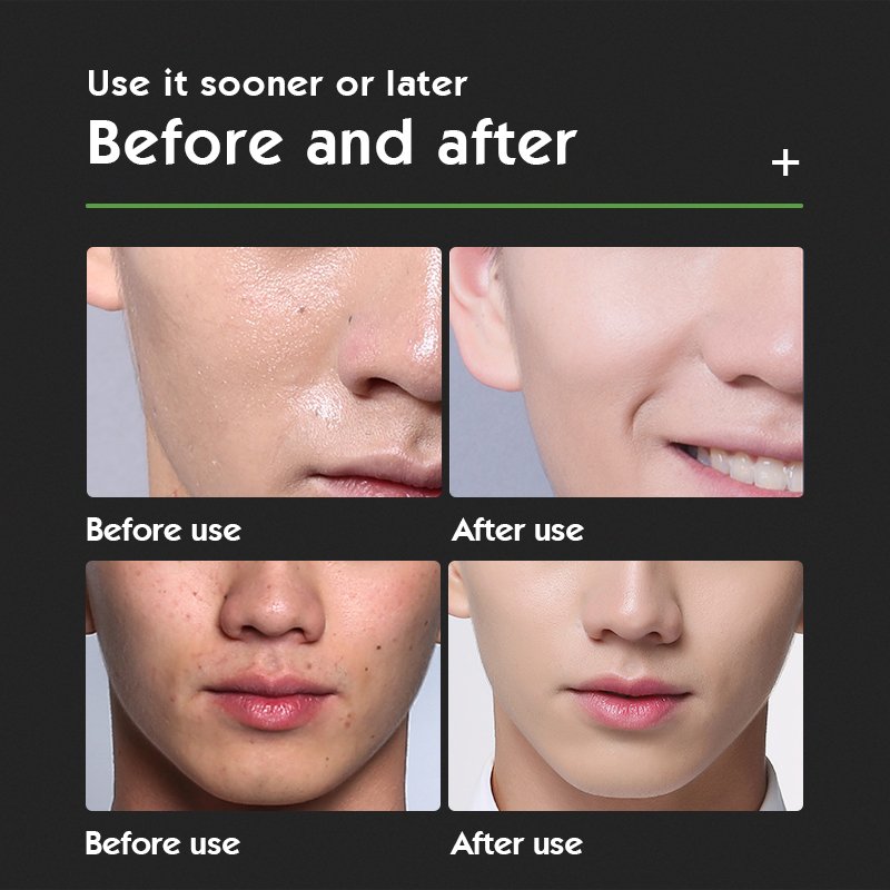 Facial Anti Acne Whitening Brightening Moisturizing Repair Exfoliator Men SKinCare Kit Products Mens Skin Care Set