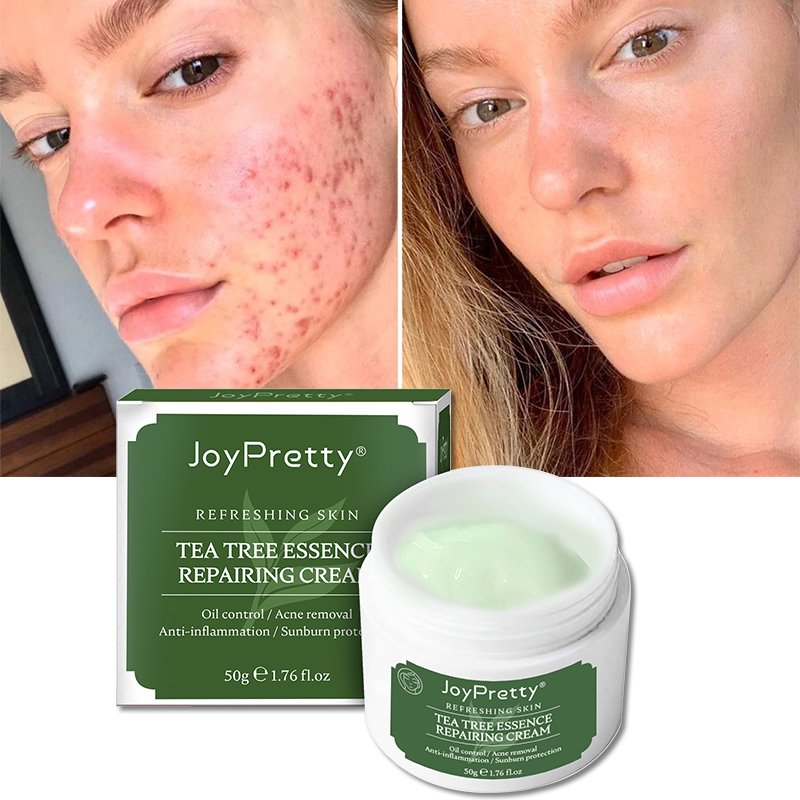 Korea Organic Skincare Pimples Remover Anti Acne Repairing Green Tea Face Cream Acne Treatment Moisturizer