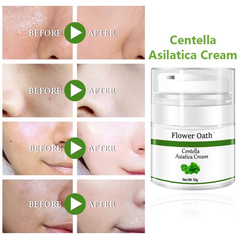 Block Sun and Remove Acne with Natural Face Cream and Whitening Ingredients 100ml 120ml Centella Asiatica Restoration face cream