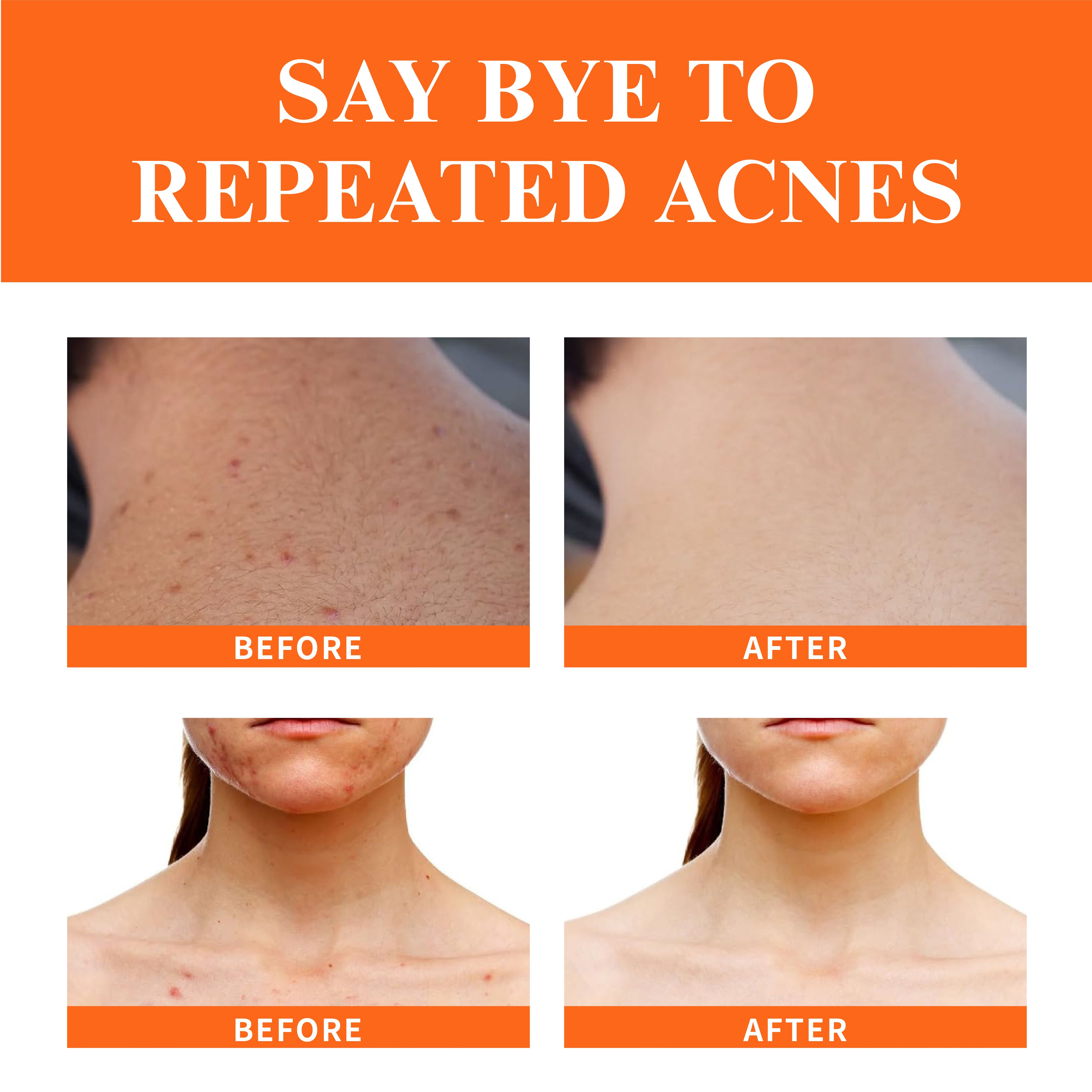 Private Label 1 Week Fast Scar Prevention Repair Treatment Moisturizer Anti Acne Face Cream For Face