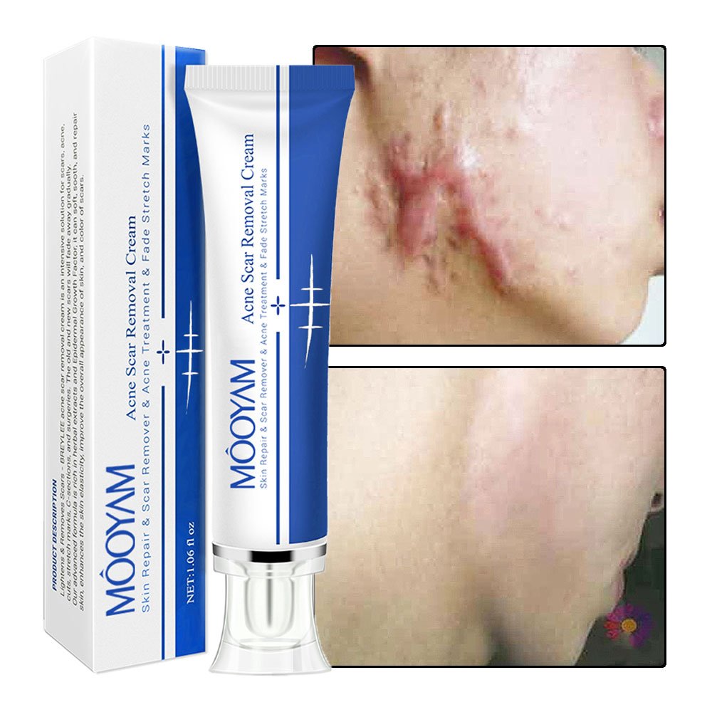 Vitamin-Infused Strong Effective Cream for Acne Scar Pimple Stretch Mark Removal Face Gel Tummy Tuck Tightening Cream Body Use