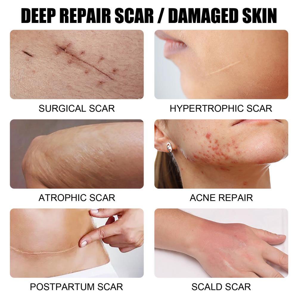 Vitamin-Infused Strong Effective Cream for Acne Scar Pimple Stretch Mark Removal Face Gel Tummy Tuck Tightening Cream Body Use