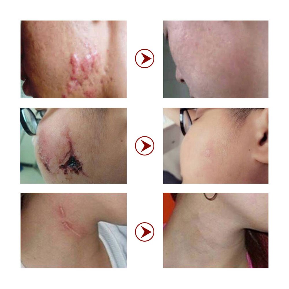 Vitamin-Infused Strong Effective Cream for Acne Scar Pimple Stretch Mark Removal Face Gel Tummy Tuck Tightening Cream Body Use
