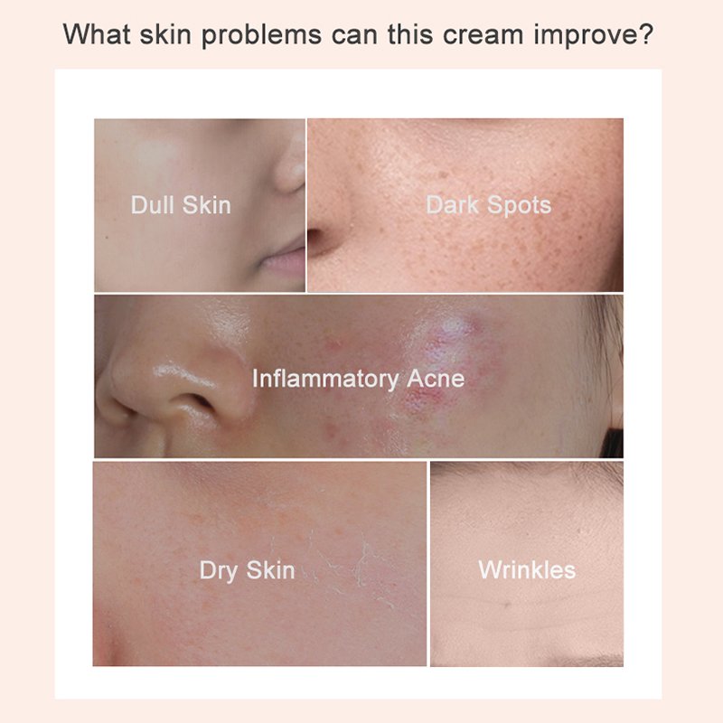 Whitening Cream for Face Paraben-Free Moisturizer Anti-Acne & Nicotinamide Kojic Acid and Turmeric Face Cream