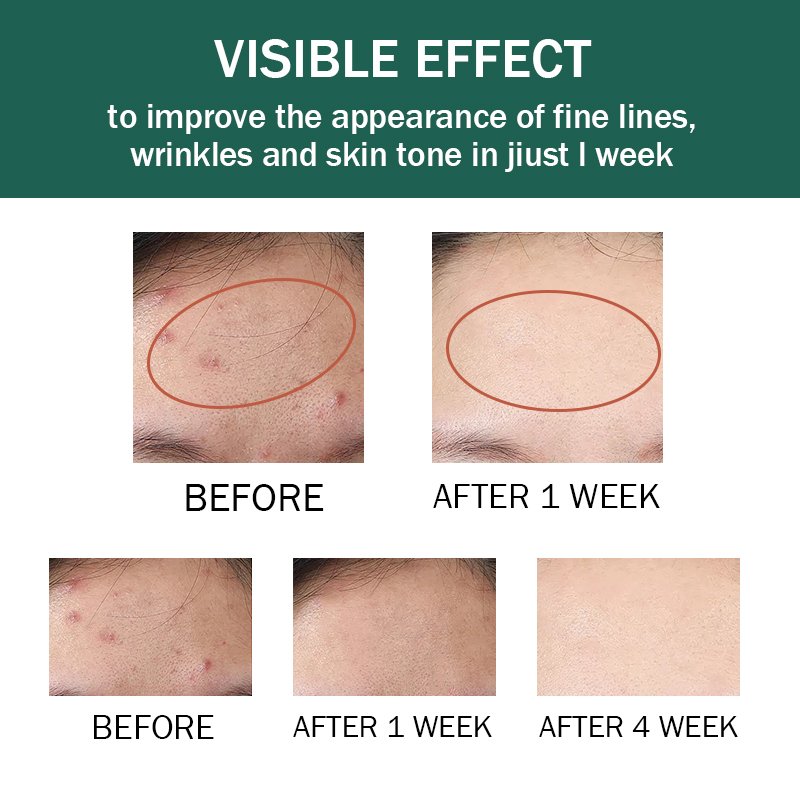 Acne treatment cream Face Products Skin Care Natural Collagen Peptides Moisturizing Whitening Anti-Aging Face Cream
