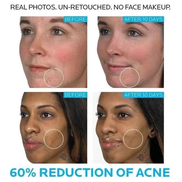 whitening and moisturizing Acne removing and repairing serum Soothing face cream Anti acne lotion 40ml