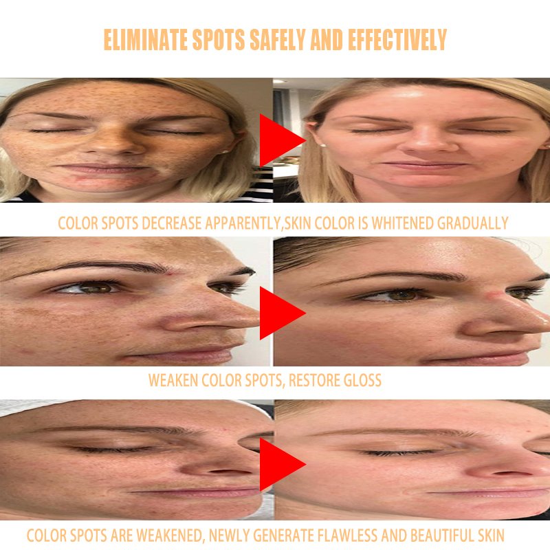 oem vitamin c anti aging wrinkle dark spot remover,private label kojic acid freckle remover,whitening face cream