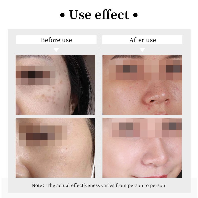 Customised Skin Care Natural Lightening Freckle Blemish Melasma Dark Spot Corrector Whitening Face Cream