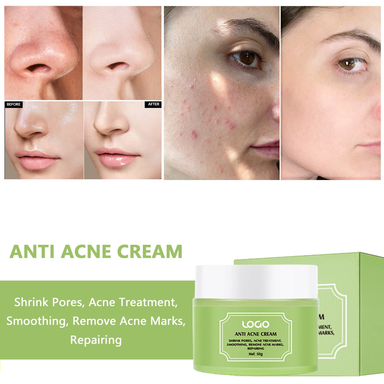 OEM Private Label Organic Tea Tree Acne Scar Removal Whitening Face Cream for Acne
