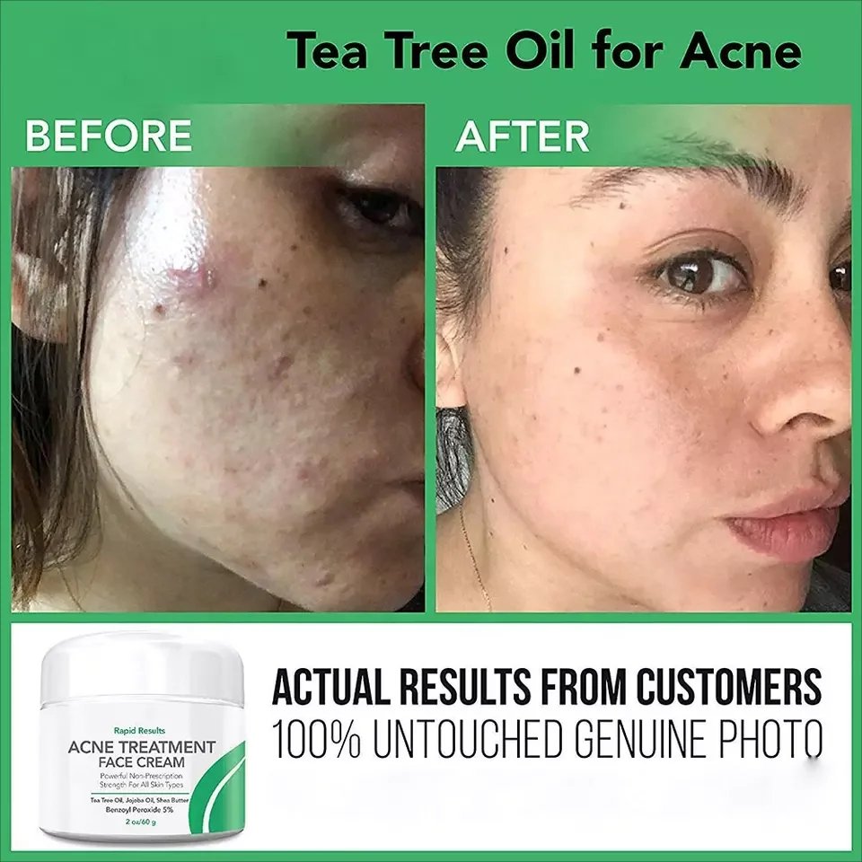 Private label OEM skin care beauty benzoyl peroxide acne treatment cream anti acne pimple tea tree oil Face Cream