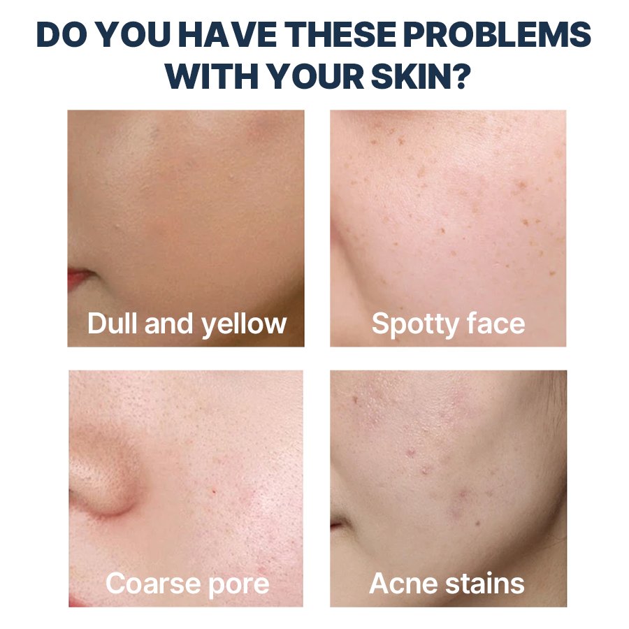 Strong Face Cream & Lotion for Pimple Melasma Blemish Dark Spot Freckle Removal Bleaching Whitening