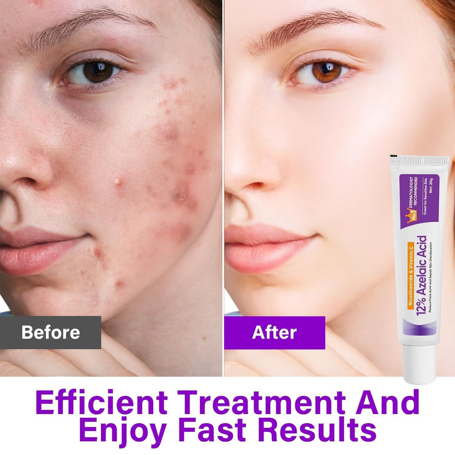 OEM Azelaic Acid Soothing and Acne Removing Ointment Lightening Acne Marks Soothing and Moisturizing Acne Repair face cream