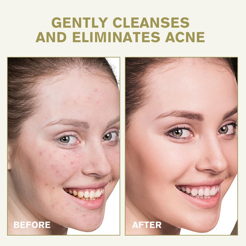 Private Label Facial Cleanser Paraben-free Acne Treatment & Whitening and Organic Vegan & Turmeric Facial Deep Cleanser