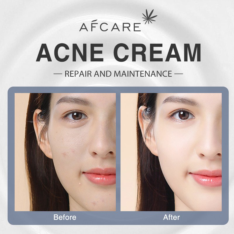 Best Face Cream for Skin Paraben-free Anti-Acne & Repair and Centella & Ceramide Moisturizing Face Cream With My Logo