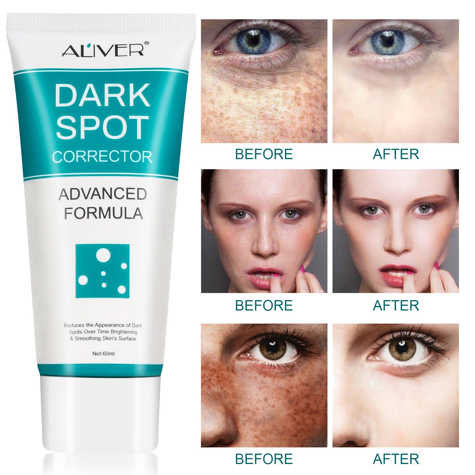ALIVER Facial Care Freckle Melasma Removal Corrector Whitening Dark Spot Remover Face Cream