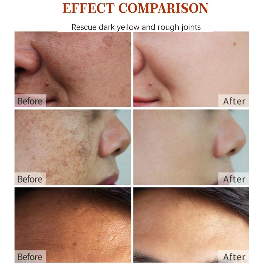 Pimples Melasma Blemish Removal Dark Spot Remover Cream Strong Bleaching Whitening Face Freckles Remove Corrector Cream