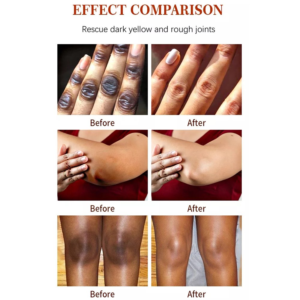 Pimples Melasma Blemish Removal Dark Spot Remover Cream Strong Bleaching Whitening Face Freckles Remove Corrector Cream