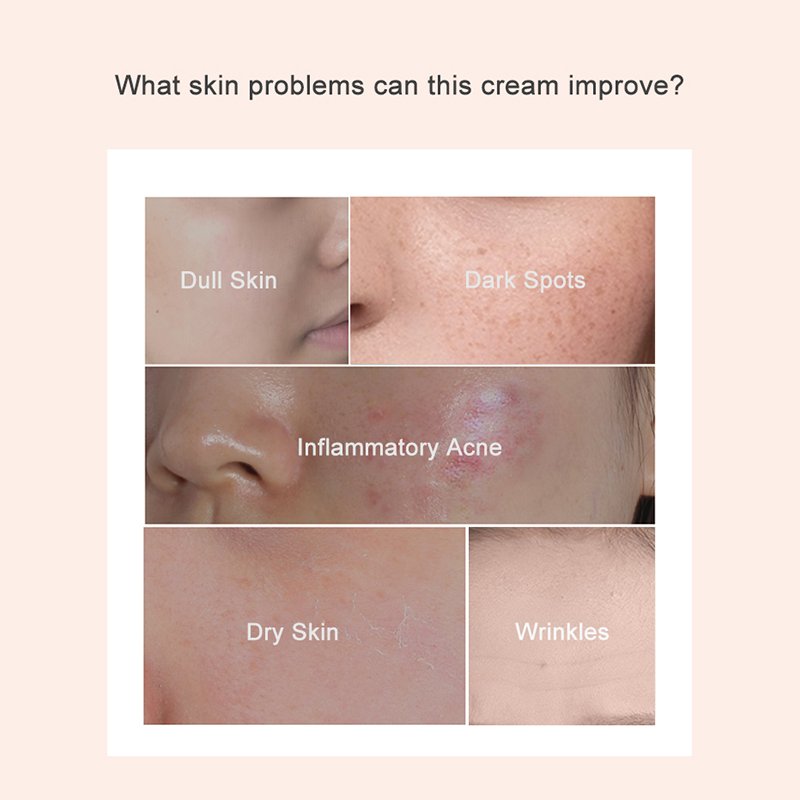 Private Label Organic Natural Anti-Aging Acne Treatment Facial Skin Pimple Turmeric Face Cream