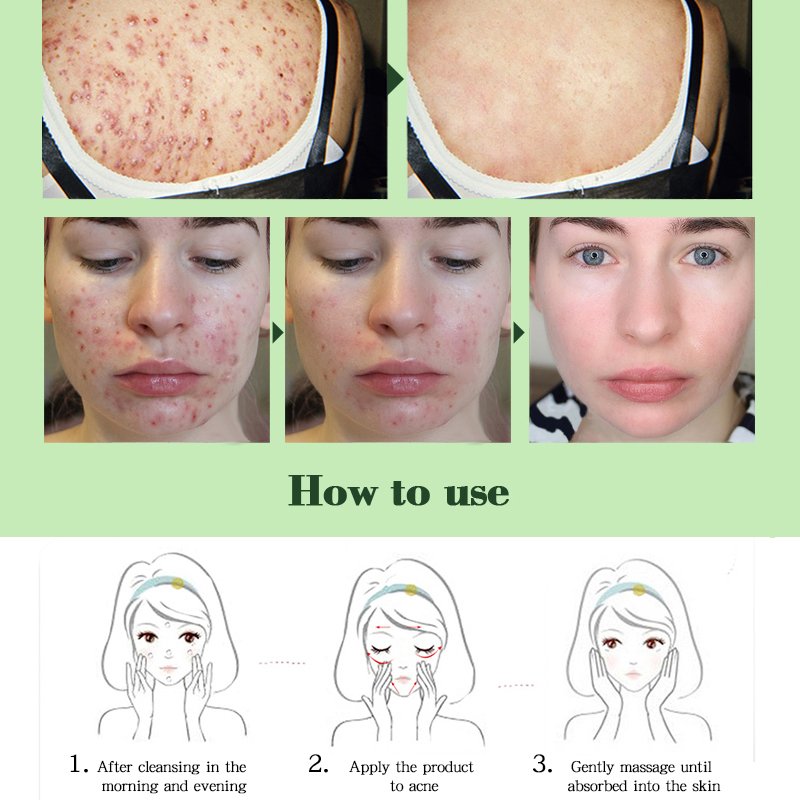 Private label Best Organic Acne Cream Acne Scars Remover Anti Acne Scar Pimple Face Cream