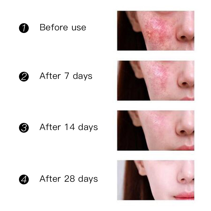 Private label Best Organic Acne Cream Acne Scars Remover Anti Acne Scar Pimple Face Cream