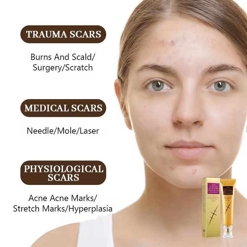 OEM ODM Custom Facial Cream Dark Spot Anti Acne Removal Ance Lightening Scar Removing Face Cream For Old Scars On Face Legs