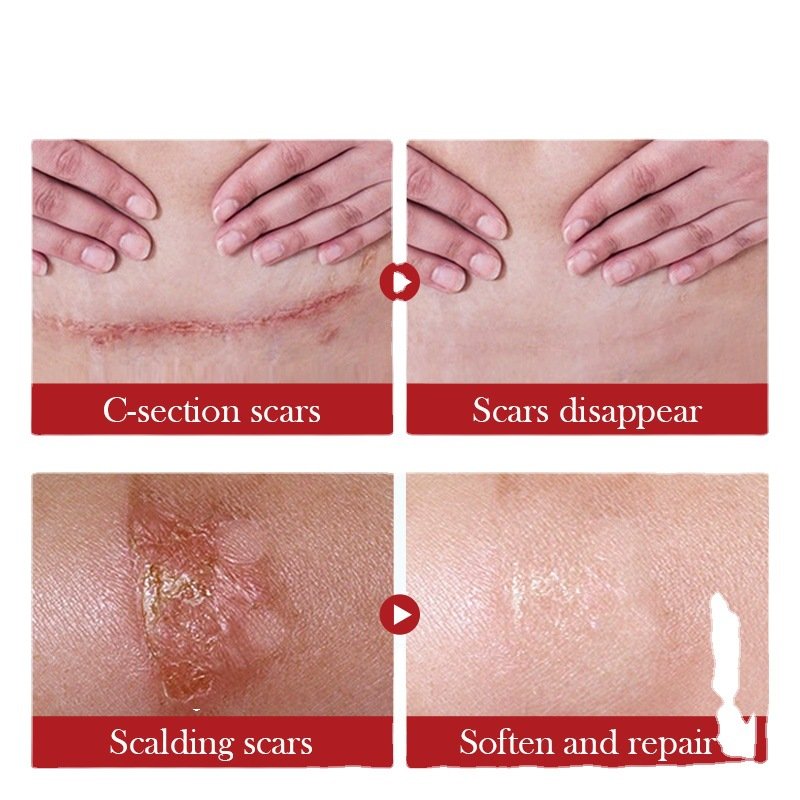 Skin Care Dark Spot Repair Gel Face Pimples Acne Scar Mark Removal Cream Repair Herbal Skin Care Scar Repair Cream