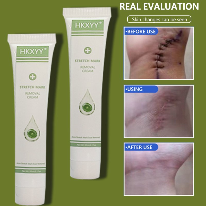 powerful Acne Pimples Stretch Marks Scar Removing,Scar Removal Cream for Old Scars On Face And Legs,Body Scar Removal Cream