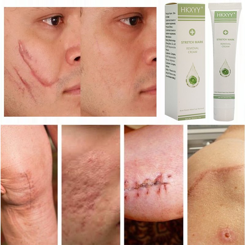 powerful Acne Pimples Stretch Marks Scar Removing,Scar Removal Cream for Old Scars On Face And Legs,Body Scar Removal Cream