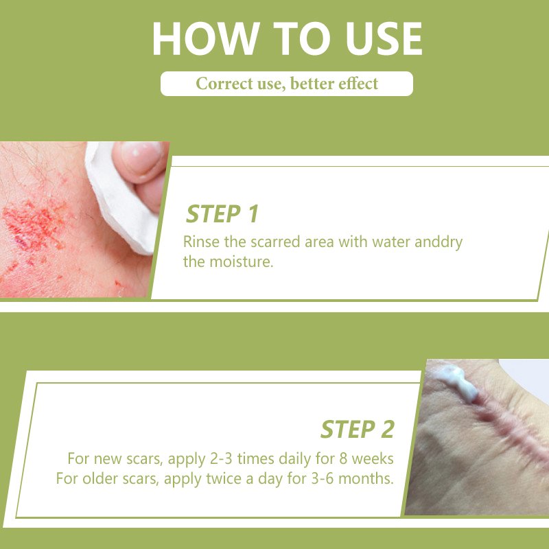 powerful Acne Pimples Stretch Marks Scar Removing,Scar Removal Cream for Old Scars On Face And Legs,Body Scar Removal Cream