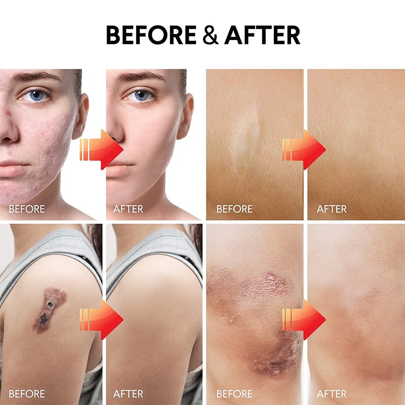 powerful Acne Pimples Stretch Marks Scar Removing,Scar Removal Cream for Old Scars On Face And Legs,Body Scar Removal Cream