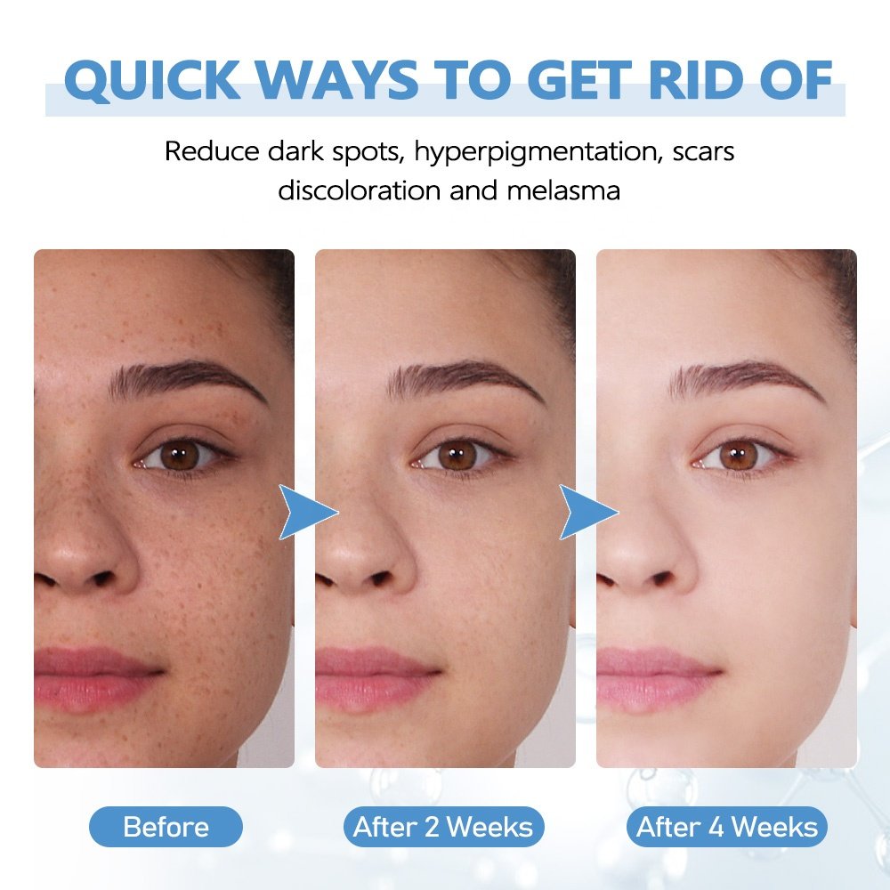 Facial Lightening Freckle Blemish Pimples Melasma Dark Spot Corrector Remover Face Cream for Dark Skin