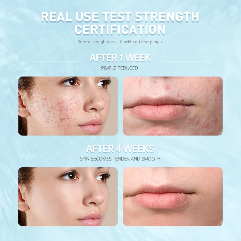 Korean Cosmetics Skin Care Acne Treatment Salicylic Acid Oil Shrink Pores Moisturizing Beauty Face Cream