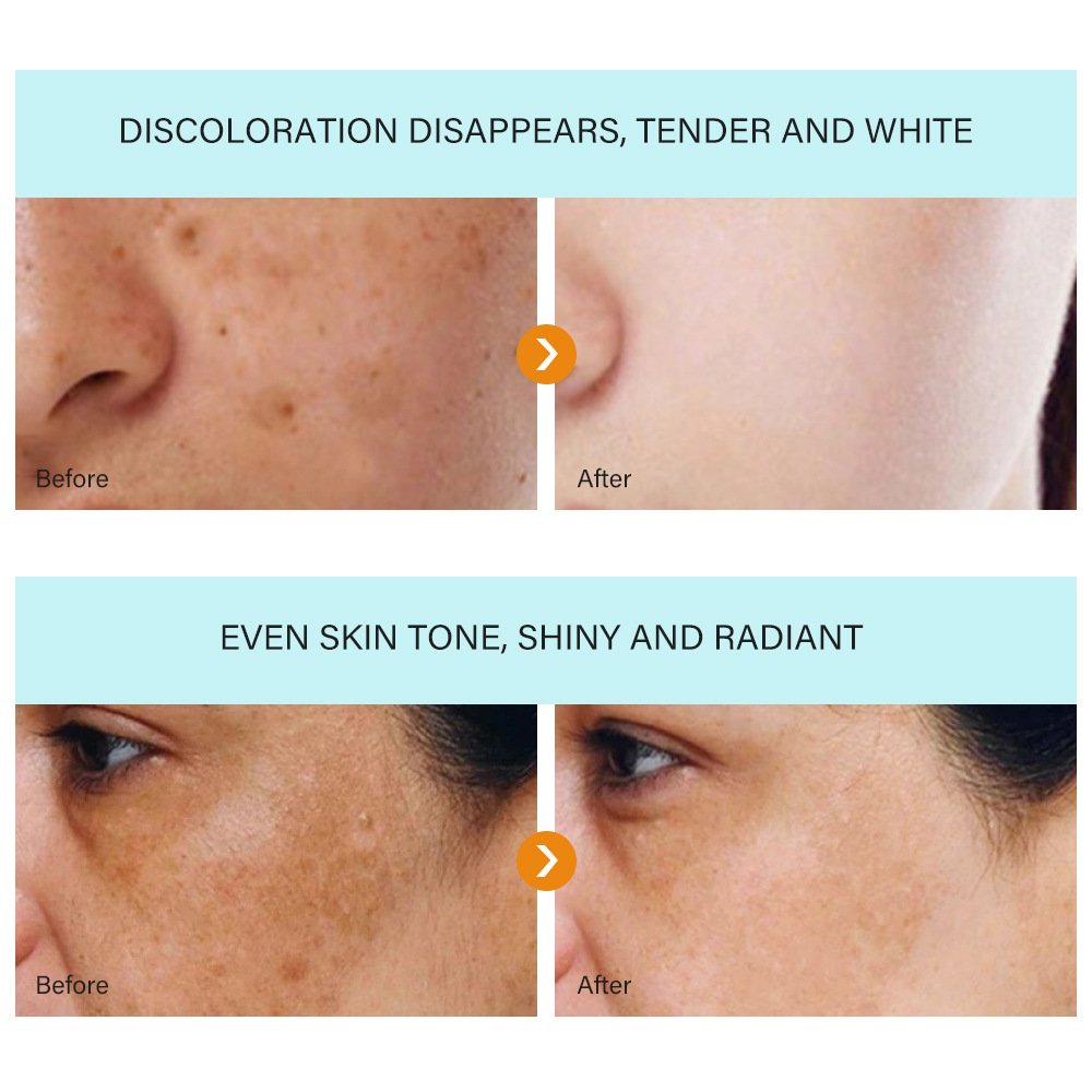 Wholesale Whitening Freckles Cream Remove Melasma Dark Spots Lighten Melanin Remover Moisturizing Brightening Face Skin Care