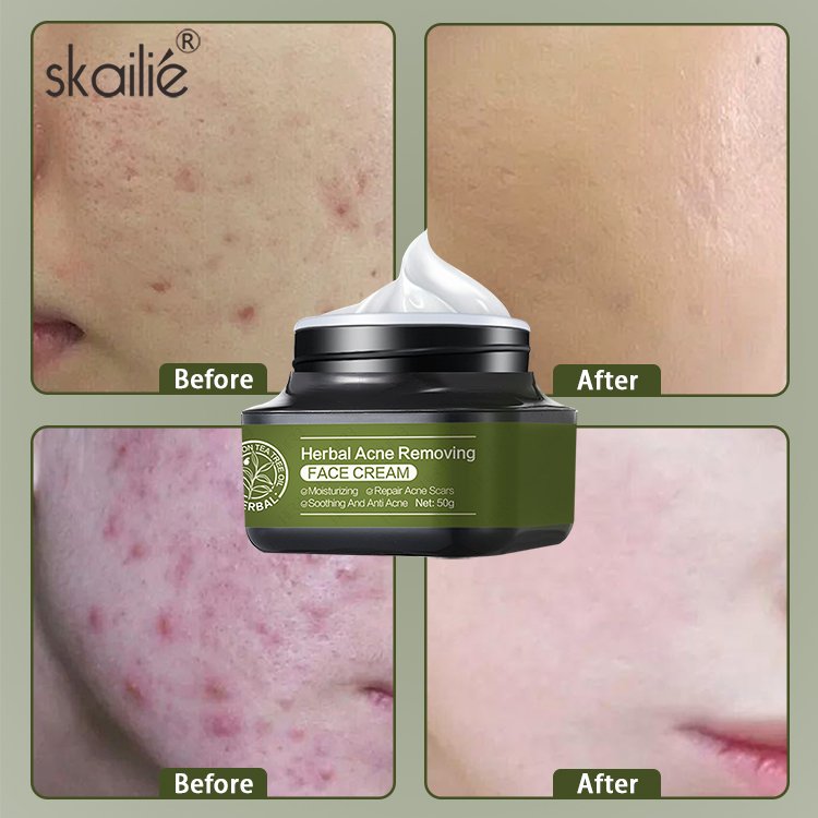 Private Label Oil Control Shrink Pores Moisturizing Acne Scar Removal Anti Acne Whitening Face Cream