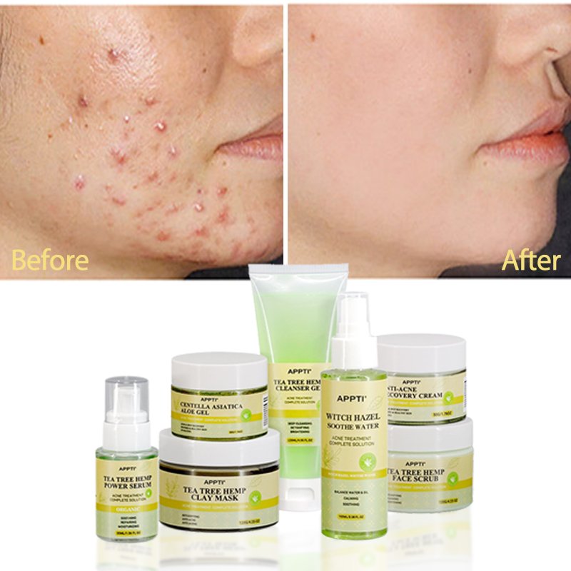 Private Label Tea Tree Skin Care Serum Product Hyaluronic Acid Vitamin E Acne Cream Skin Care Set Acne Treatment Skin Care Set