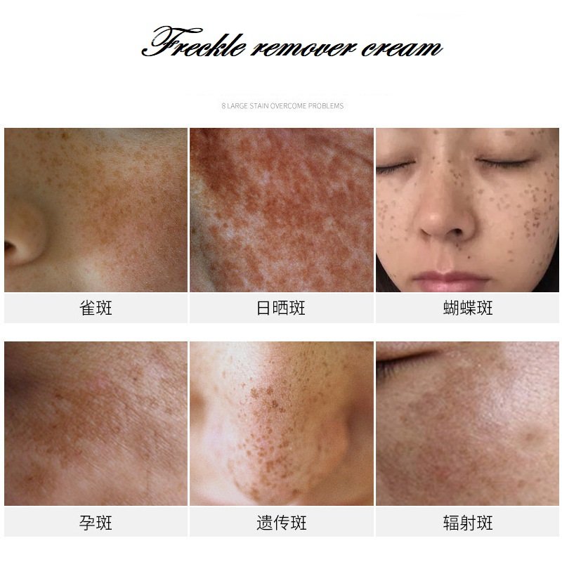 7-day quick spot removing cream semi-finished freckle removing face cream dark spot removing face whitening cream
