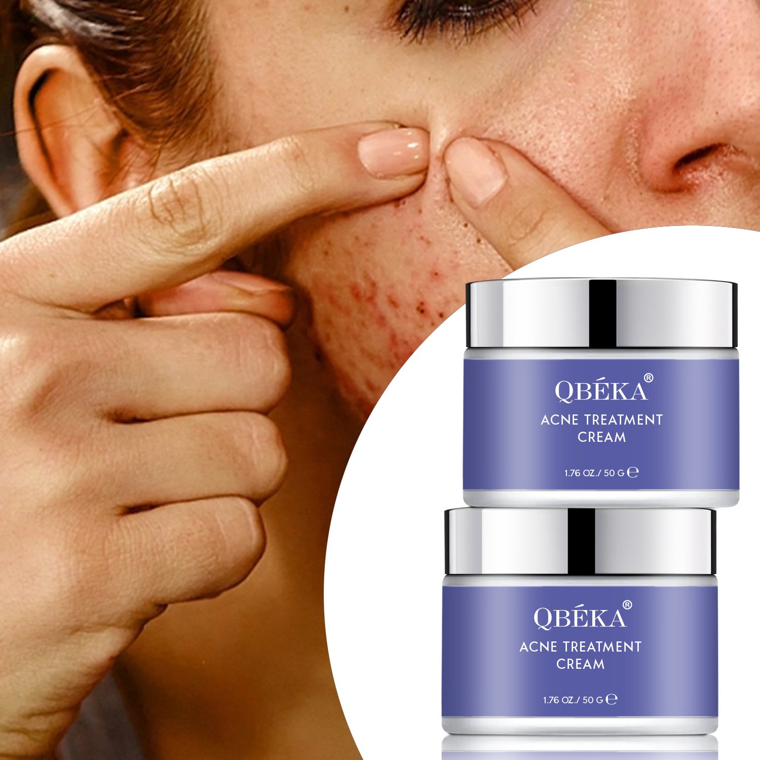 Wholesale Natural Organic Acne Treatment Cream, Removal Acne Treatment Face Cream, Repair Acne Scar Pimples