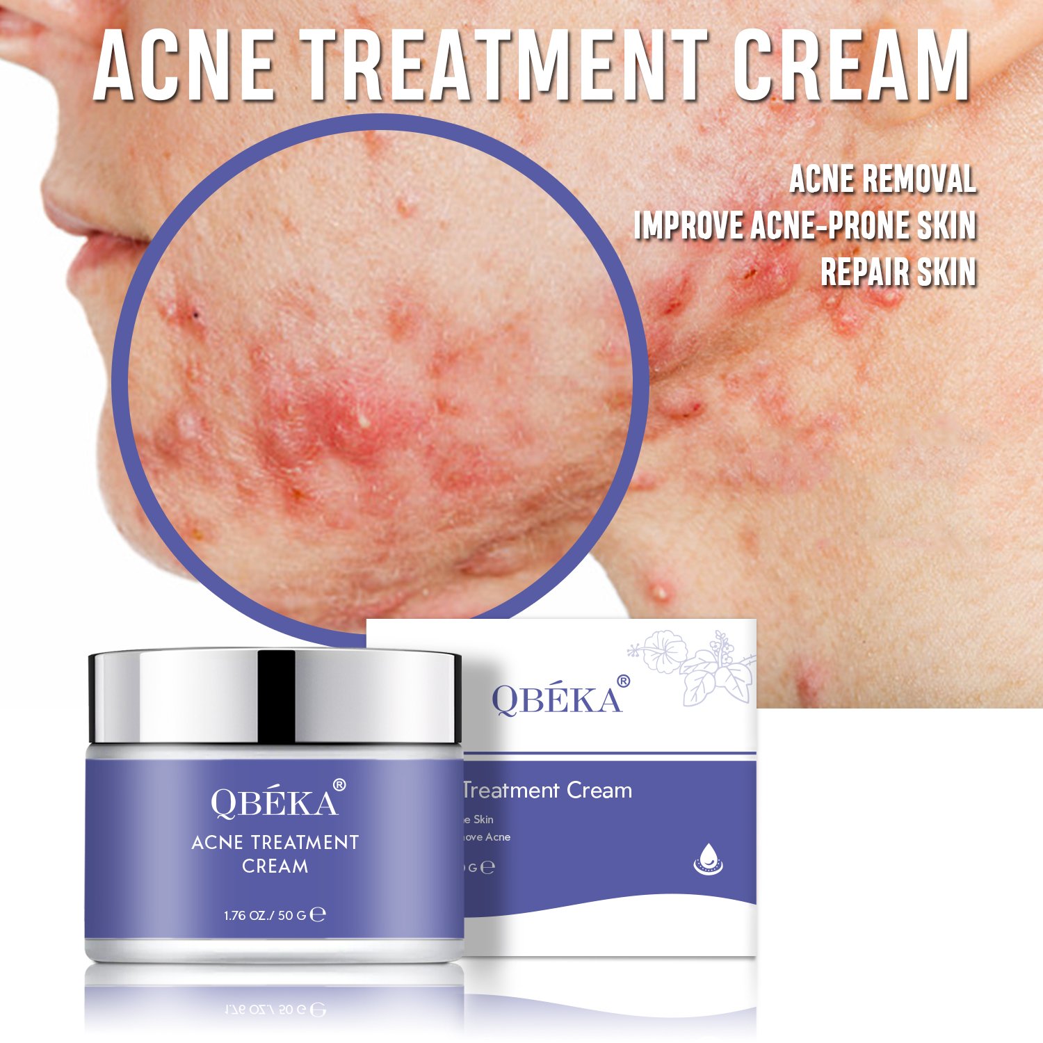 Wholesale Natural Organic Acne Treatment Cream, Removal Acne Treatment Face Cream, Repair Acne Scar Pimples