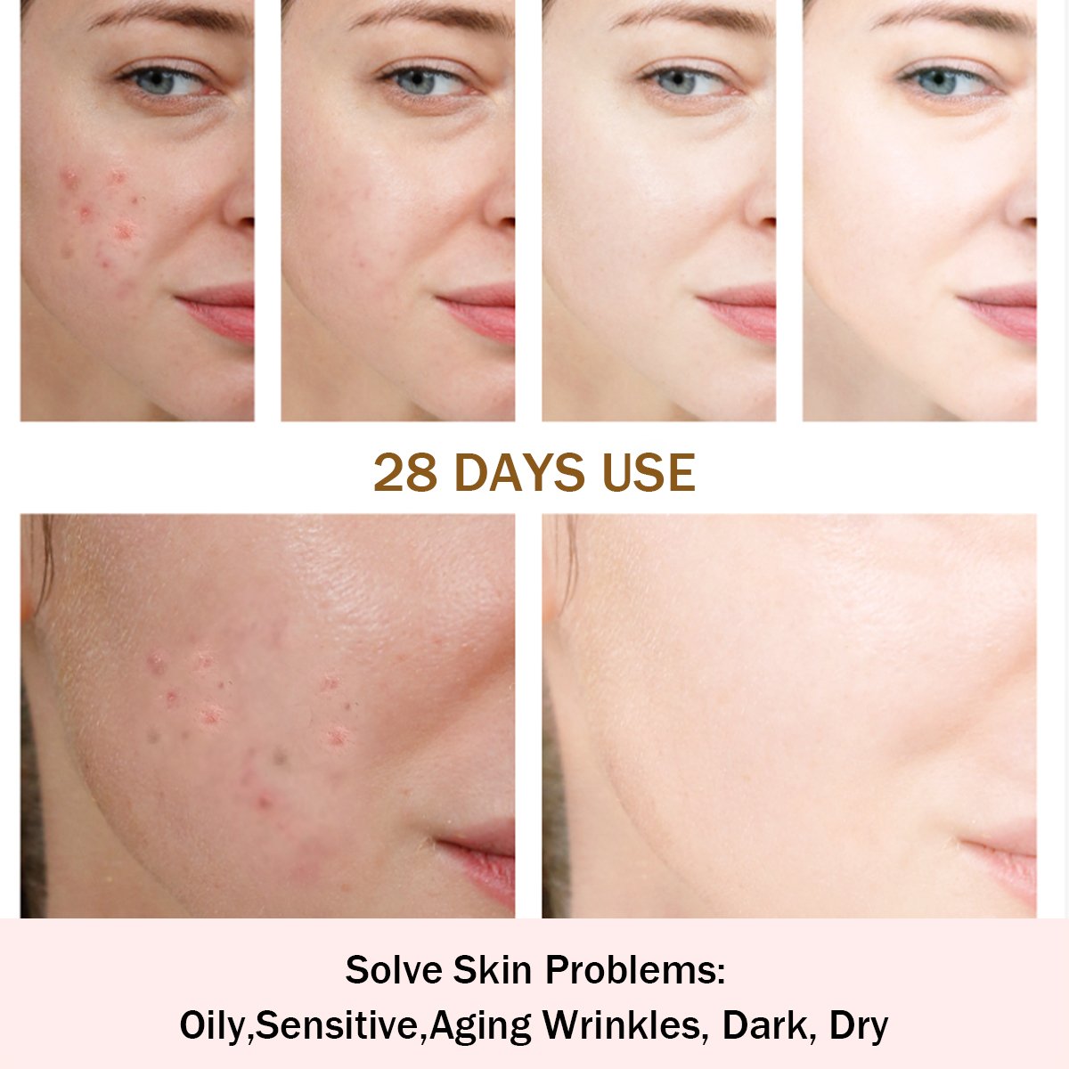 Acne treatment cream Acid Sun Bleaching Dark Spot Removing Skin Care Beauty Products Whitening Face Cream