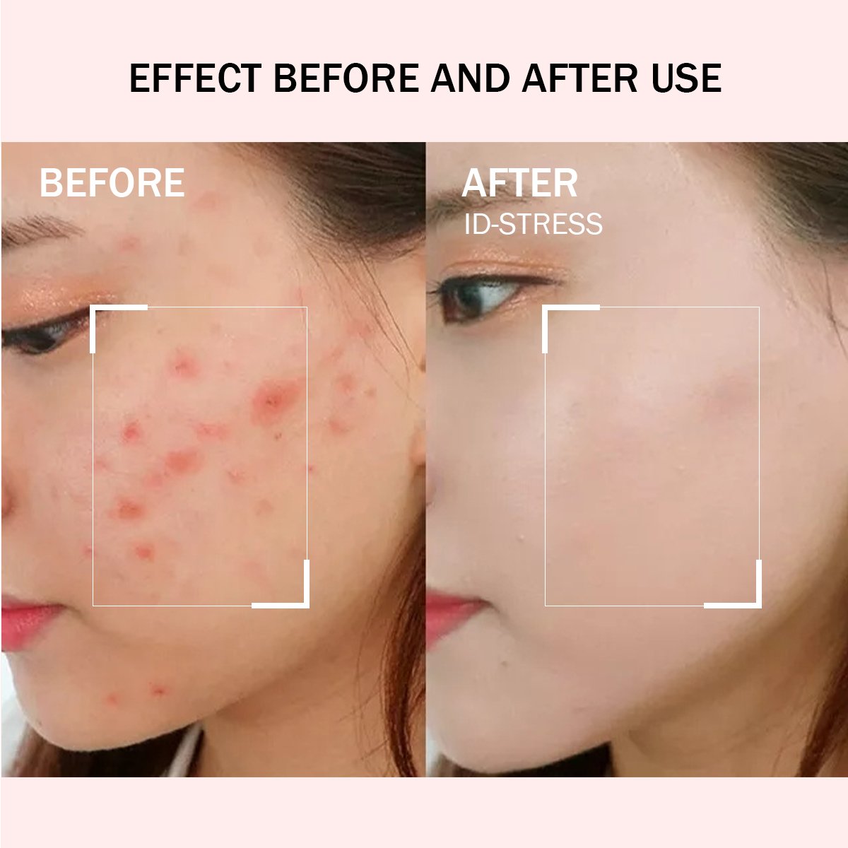 Acne treatment cream Acid Sun Bleaching Dark Spot Removing Skin Care Beauty Products Whitening Face Cream