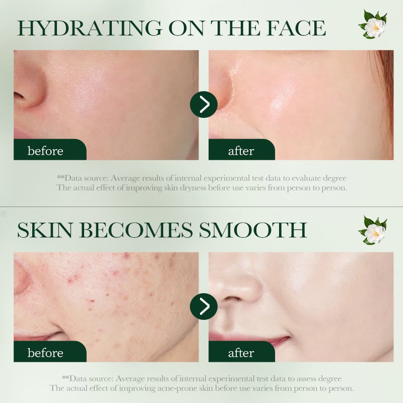Tea Tree Face Cream Lotion Whitening Anti Acne Treatment Beauty Skin Care Moisturizing Nourishing Firming Facial Cream Day 5000