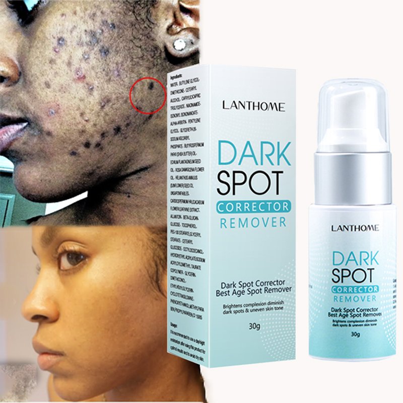 OEM Custom Natural Herbal blemish Serum Freckle Pimples Dark Spot Removal Corrector Anti-Acne Repairing Whitening Face Cream
