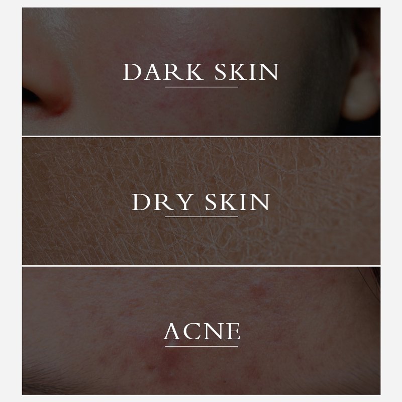 Pimples dark spot remover cream dark spots Brightening Turmeric Pimple Remover Face Cream