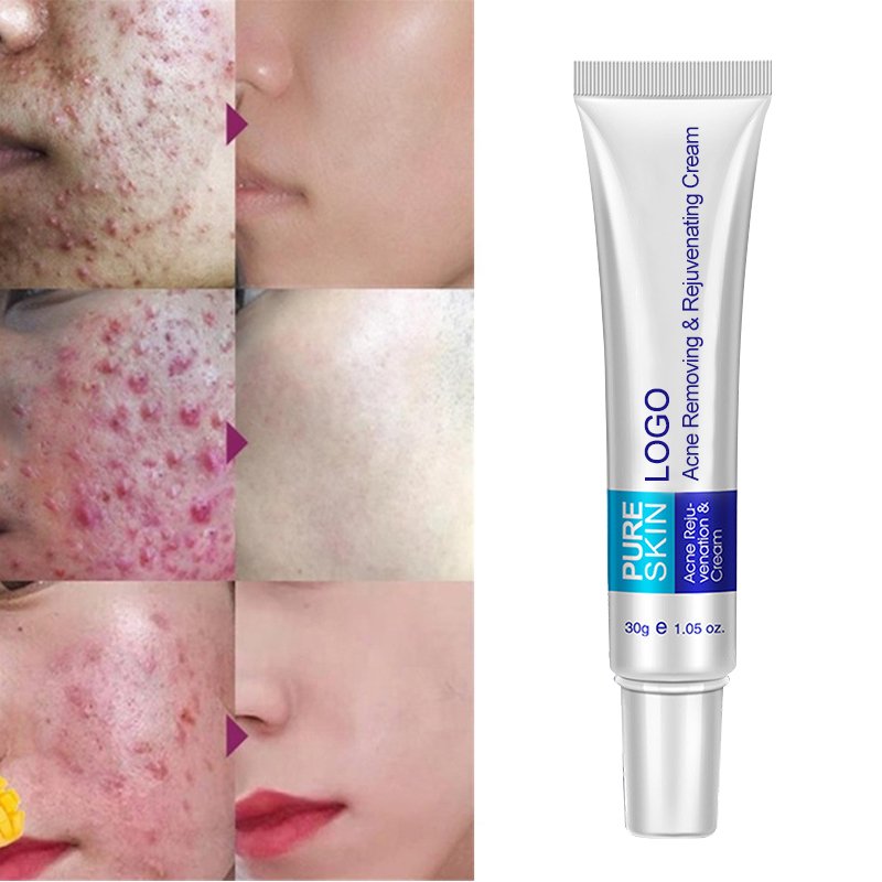 Collagen Vitamin Moisturizing Anti Aging Aloe Cream Skin Pimple Removal Lighting best anti Acne Face Cream