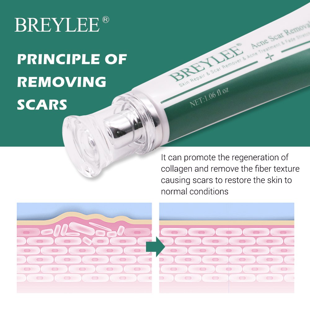 BREYLEE Acne Scar Removal Cream 30g Face Cream Skin Repair Skin Care Scar Acne Treatment Remove Stretch Marks Whitening Cream