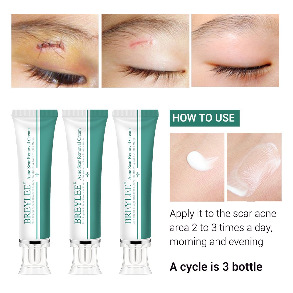 BREYLEE Acne Scar Removal Cream 30g Face Cream Skin Repair Skin Care Scar Acne Treatment Remove Stretch Marks Whitening Cream